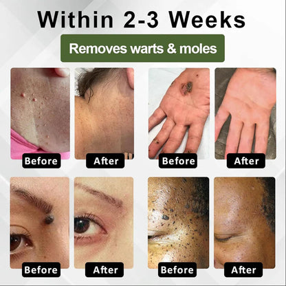 NatureErase Instant Mole Spot Removal Gel